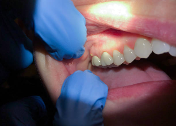 Best Knocked-Out Tooth (Avulsed Tooth) Treatment in Silt, CO