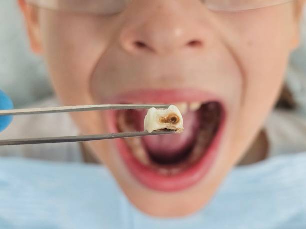 Best Emergency Treatment for Oral Infections in Silt, CO